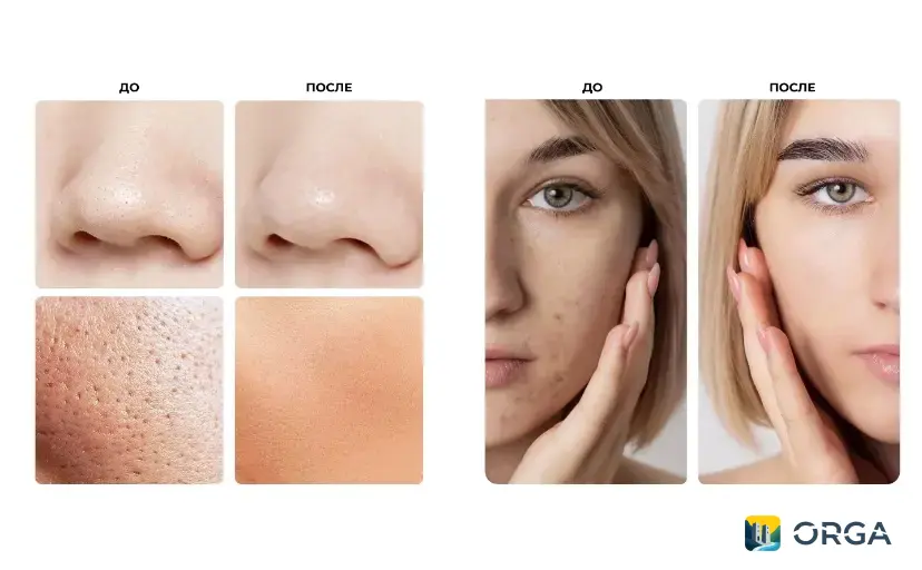 Ультразвуковая чистка лица